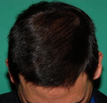 2000 Grafts with Dr. Konior - Hair Loss Surgery - Before and After Gallery