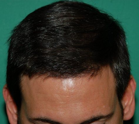 2000 Grafts with Dr. Konior - Hair Loss Surgery - Before and After Gallery