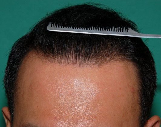 Hair Loss Surgery: 3008 Graft Frontal-Midscalp Restoration - Postop Front Comb-back View