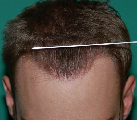 Hair Loss Surgery: 1750 Graft Hairline Restoration - Front Comb-back View