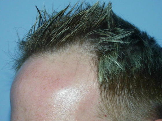 Hair Loss Surgery: 2641 High Density Frontal Hairline Restoration - Preop Left View