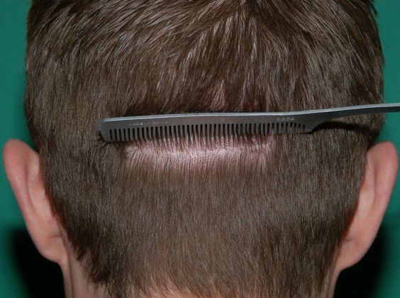 Hair Loss Surgery: 2197 Frontal-Midscalp Restoration - Postop Donor Incision Line