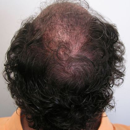 Crown Hair Restoration - Male: Crown (8) - Post-op FUT hair transplant