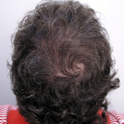 Crown Hair Restoration - Male: Crown (8) - After FUT hair transplant