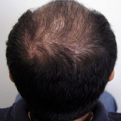 Crown (5) - Male Before and After Crown Hair Restoration Photos ...