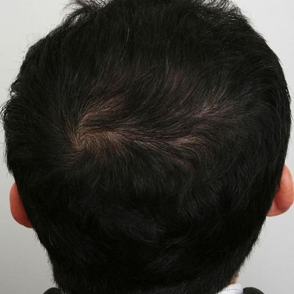 Crown (5) - Male Before and After Crown Hair Restoration Photos ...