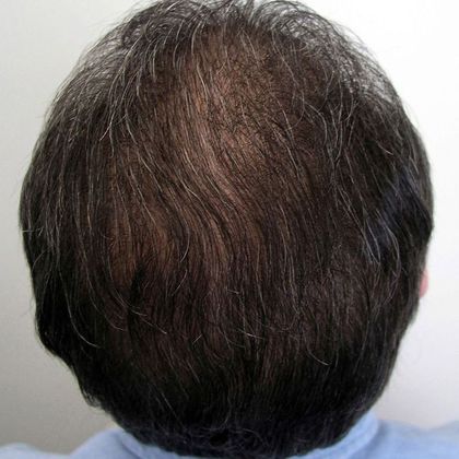 Crown (6) - Male Before and After Crown Hair Restoration Photos ...