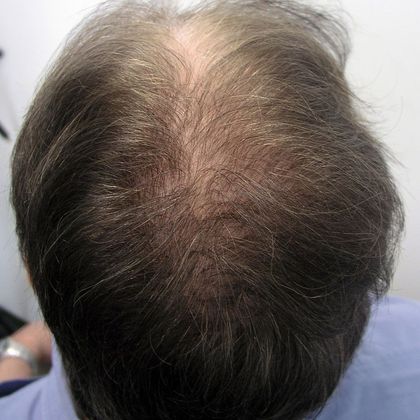 Crown (7) - Male Before and After Crown Hair Restoration Photos ...