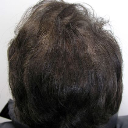 Male Before and After Crown Hair Restoration Photos: Crown (7) - After