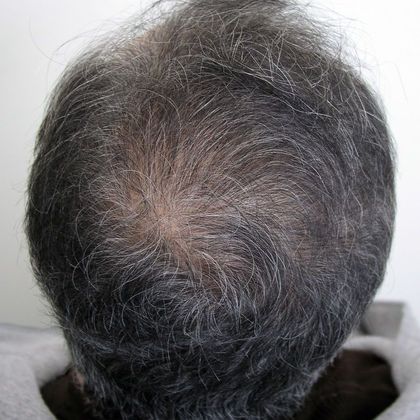Crown Hair Restoration - Male: Crown (9) - Before
