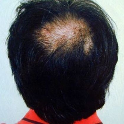 Crown Hair Restoration - Male: Crown (11) - Before