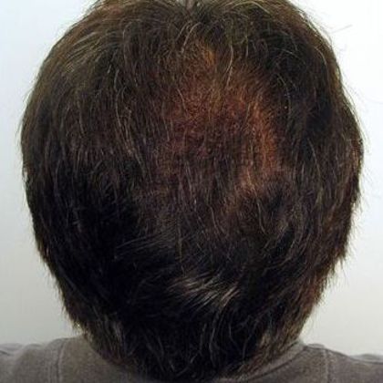 Crown Hair Restoration - Male: Crown (11) - After