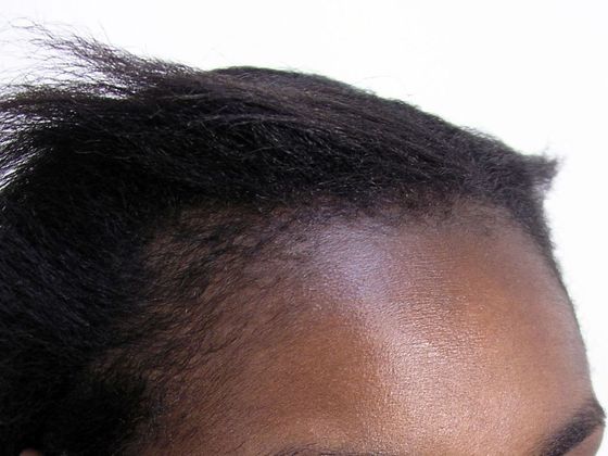 Hair Transplant - Female: Traction Alopecia FUT (4) - Before female hair transplant