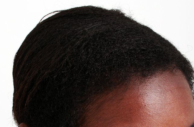 Hair Transplant - Female: Traction Alopecia FUT (4) - After female hair transplant