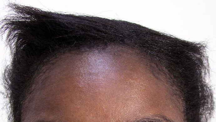 black female hair transplant - Female Before And After Hair Transplant ...