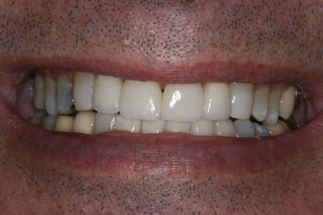 Porcelain Veneers: Case 1 - after