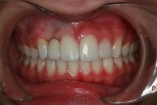 Bonded Maryland Bridge: Adam - AFTER