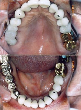 Neuromuscular Rehabilitation Case 6 - Before