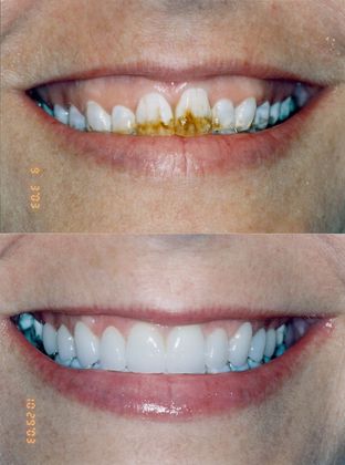 Cosmetic Makeovers Case 8 - Before