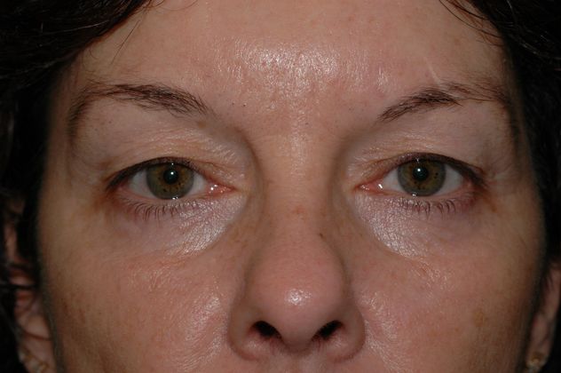 Eyelid Surgery Case 1 - Indianapolis, IN - Before