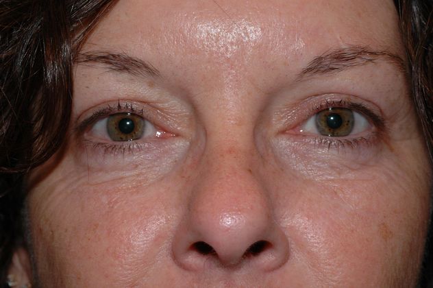 Eyelid Surgery Case 1 - Indianapolis, IN - After