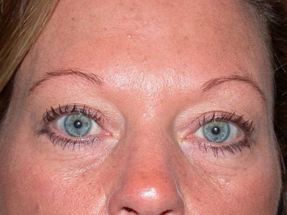 Eyelid Surgery: Case 3 - Zionsville, IN - Before