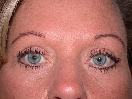 Eyelid Surgery: Case 3 - Zionsville, IN - After