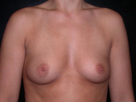 Breast Augmentation Case 1 - Indianapolis, IN - Before