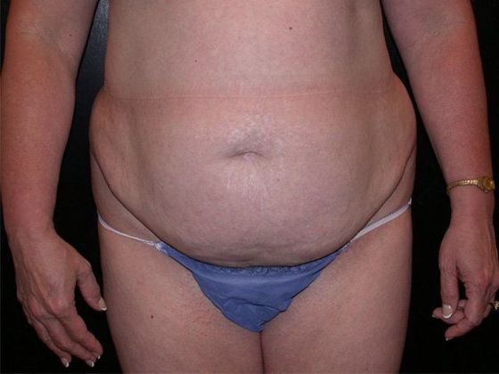 Abdominoplasty Case 1 - Indianapolis, IN - Before