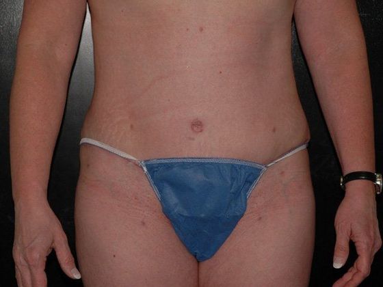 Abdominoplasty Case 1 - Indianapolis, IN - After