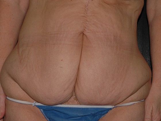 Abdominoplasty Case 2 - Zionsville, IN - Before
