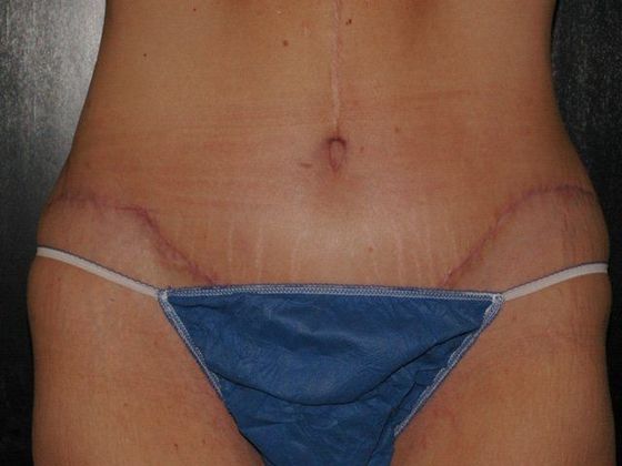 Abdominoplasty Case 2 - Zionsville, IN - After