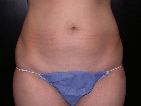 Liposuction: Case 1 - Carmel, IN - Before