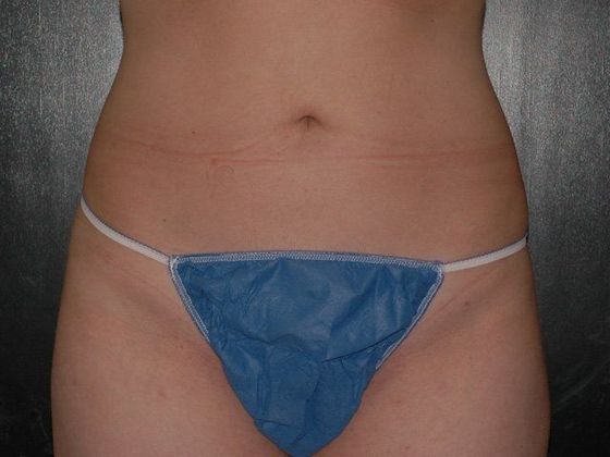 Liposuction: Case 1 - Carmel, IN - After