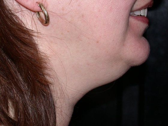 Liposuction: Case 5 - Zionsville - Before