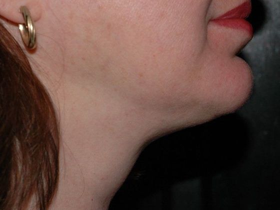 Liposuction: Case 5 - Zionsville - After