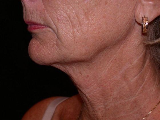 Facelift Case 1 - Carmel  - Before