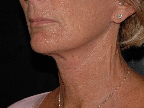 Facelift Case 1 - Carmel  - After
