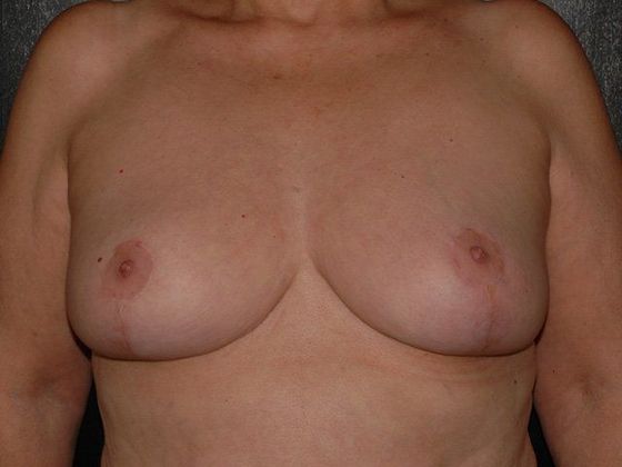 Breast Reduction Case 1 - Carmel, IN - After