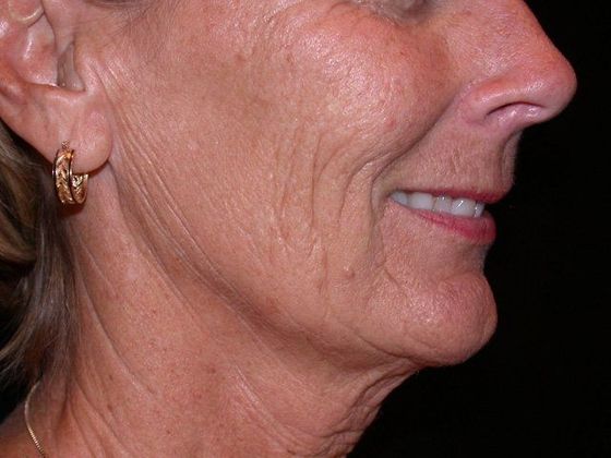 Facelift: Case 1 - Carmel - Before