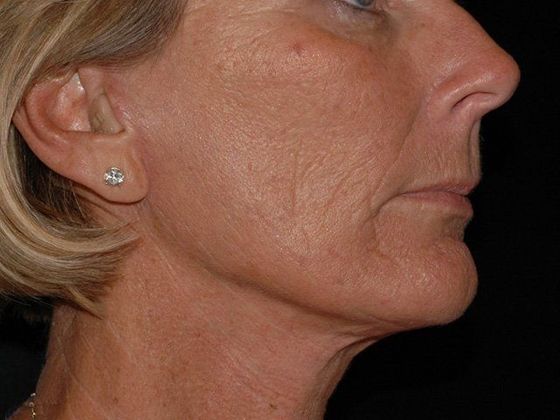Facelift: Case 1 - Carmel - After