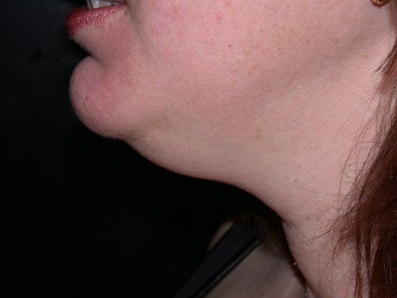 Liposuction: Case 5 - Zionsville - Before