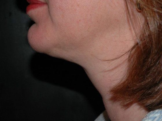 Liposuction: Case 5 - Zionsville - After