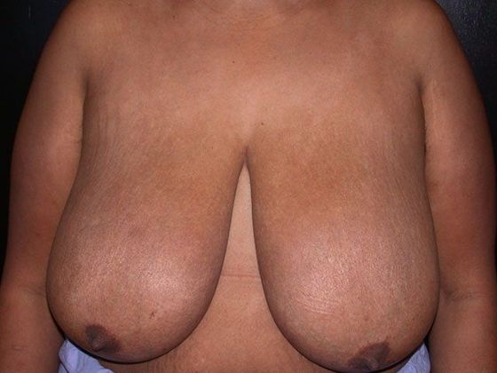 Breast Reduction Case 2 - Indianapolis, IN - Before