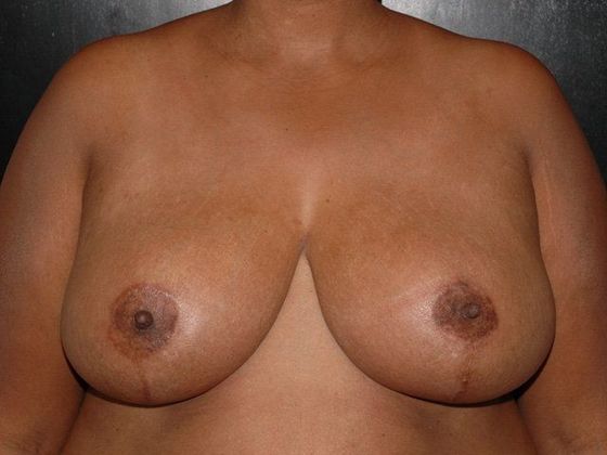 Breast Reduction Case 2 - Indianapolis, IN - After