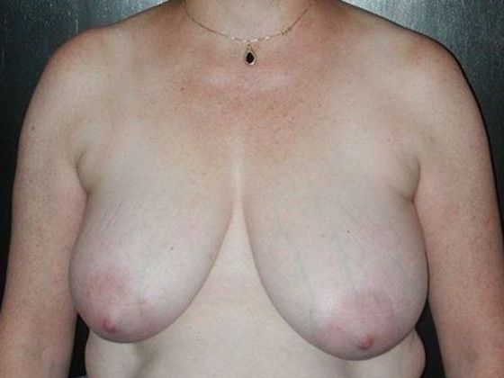 Breast Reduction Case 3 - Zionsville, IN - Before