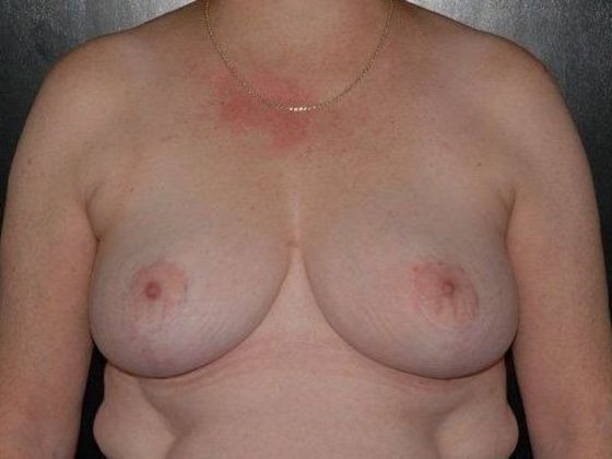 Breast Reduction Case 3 - Zionsville, IN - After