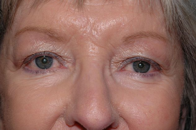 Eyelid Surgery: Case 2 - Carmel, IN - Before