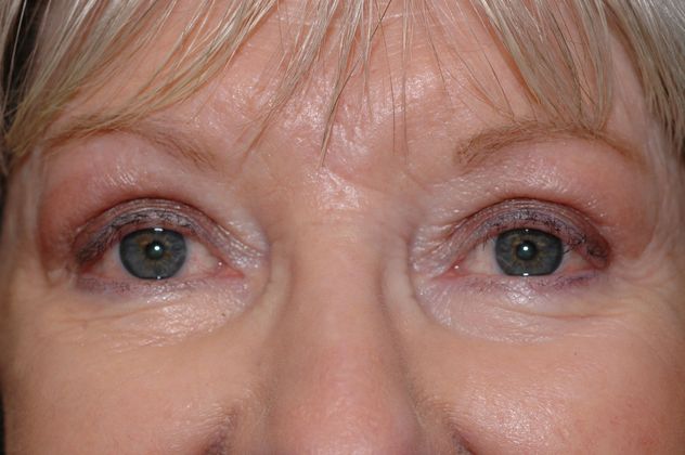 Eyelid Surgery: Case 2 - Carmel, IN - After