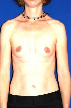 Breast Augmentation  Case 32 (13374) - Before